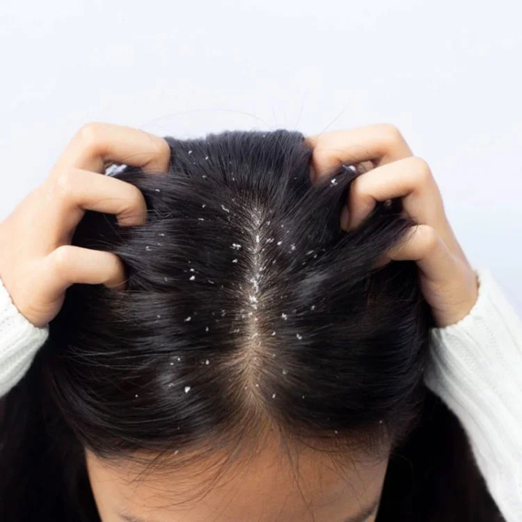 Dandruff Treatment